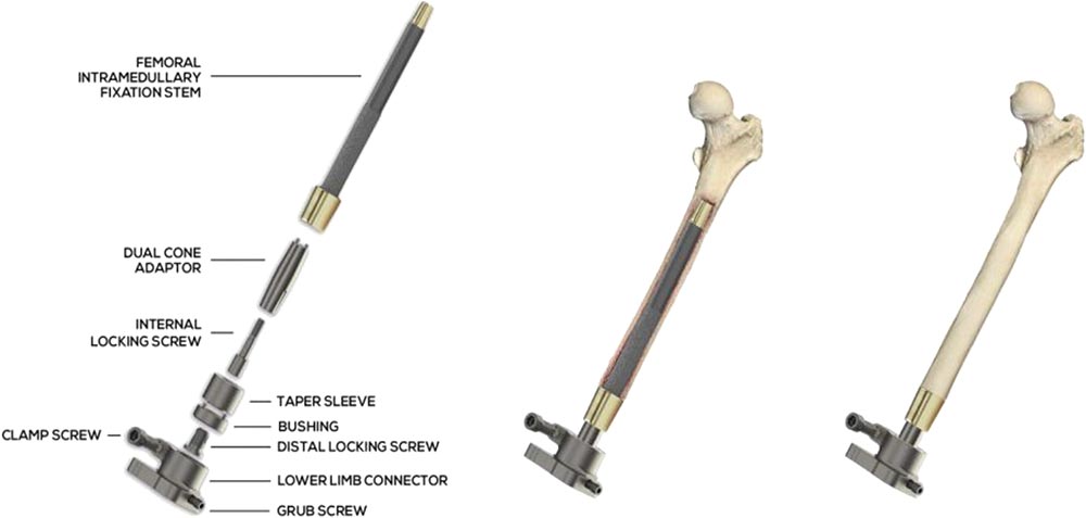 Components to Implant